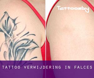 Tattoo verwijdering in Falces