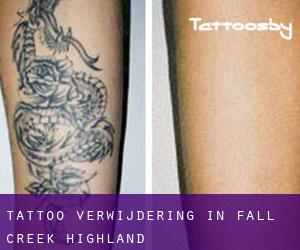 Tattoo verwijdering in Fall Creek Highland