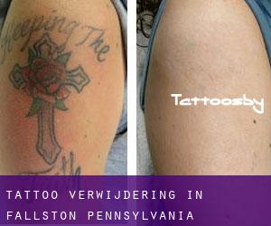 Tattoo verwijdering in Fallston (Pennsylvania)