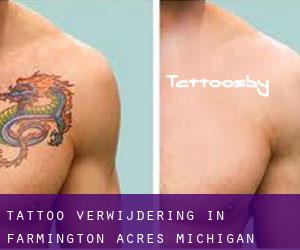 Tattoo verwijdering in Farmington Acres (Michigan)