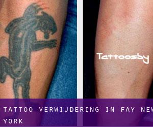 Tattoo verwijdering in Fay (New York)