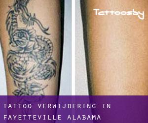 Tattoo verwijdering in Fayetteville (Alabama)