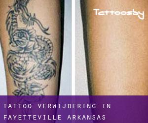 Tattoo verwijdering in Fayetteville (Arkansas)