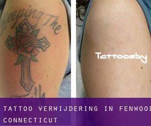 Tattoo verwijdering in Fenwood (Connecticut)