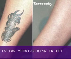 Tattoo verwijdering in Fet
