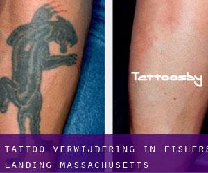Tattoo verwijdering in Fishers Landing (Massachusetts)