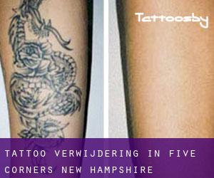 Tattoo verwijdering in Five Corners (New Hampshire)