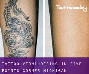 Tattoo verwijdering in Five Points Corner (Michigan)