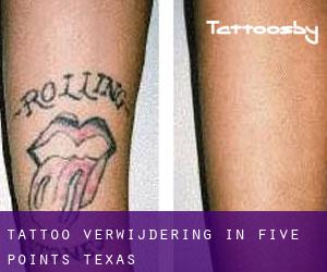 Tattoo verwijdering in Five Points (Texas)
