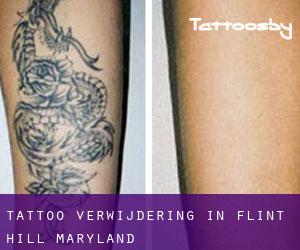 Tattoo verwijdering in Flint Hill (Maryland)