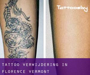 Tattoo verwijdering in Florence (Vermont)