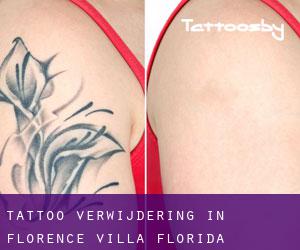 Tattoo verwijdering in Florence Villa (Florida)