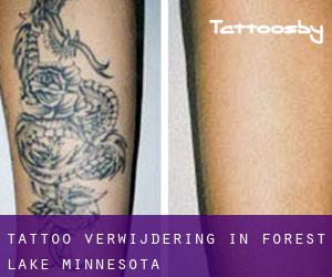 Tattoo verwijdering in Forest Lake (Minnesota)