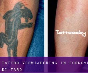 Tattoo verwijdering in Fornovo di Taro