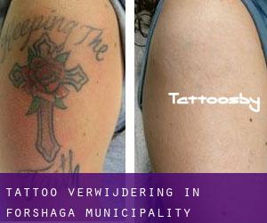 Tattoo verwijdering in Forshaga Municipality