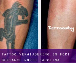 Tattoo verwijdering in Fort Defiance (North Carolina)