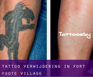 Tattoo verwijdering in Fort Foote Village