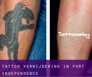 Tattoo verwijdering in Fort Independence