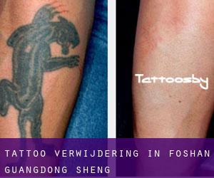 Tattoo verwijdering in Foshan (Guangdong Sheng)