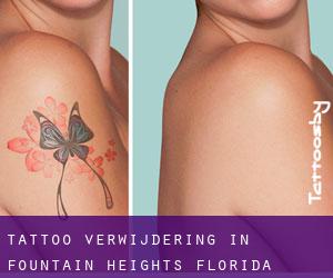 Tattoo verwijdering in Fountain Heights (Florida)