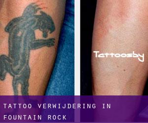 Tattoo verwijdering in Fountain Rock