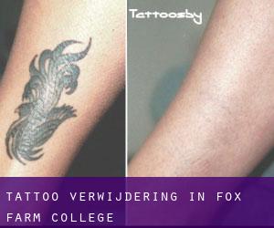 Tattoo verwijdering in Fox Farm-College