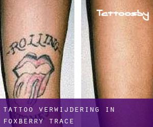 Tattoo verwijdering in Foxberry Trace