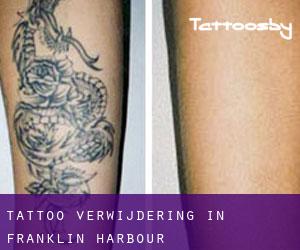 Tattoo verwijdering in Franklin Harbour