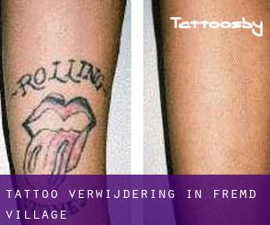 Tattoo verwijdering in Fremd Village