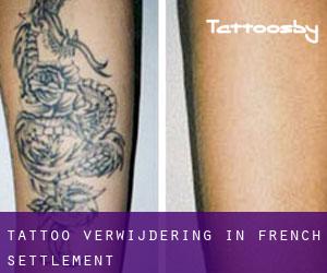 Tattoo verwijdering in French Settlement