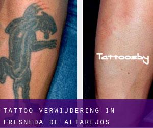 Tattoo verwijdering in Fresneda de Altarejos