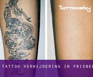 Tattoo verwijdering in Frisbee