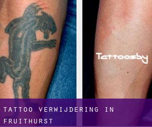 Tattoo verwijdering in Fruithurst