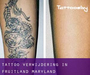 Tattoo verwijdering in Fruitland (Maryland)