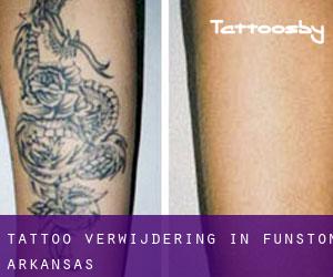 Tattoo verwijdering in Funston (Arkansas)