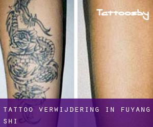 Tattoo verwijdering in Fuyang Shi