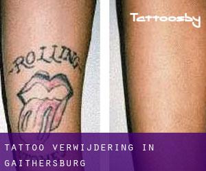 Tattoo verwijdering in Gaithersburg