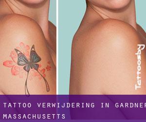 Tattoo verwijdering in Gardner (Massachusetts)