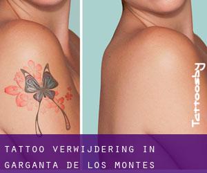 Tattoo verwijdering in Garganta de los Montes