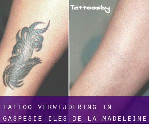 Tattoo verwijdering in Gaspésie-Îles-de-la-Madeleine