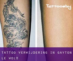 Tattoo verwijdering in Gayton le Wold