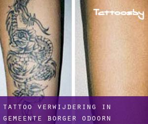 Tattoo verwijdering in Gemeente Borger-Odoorn