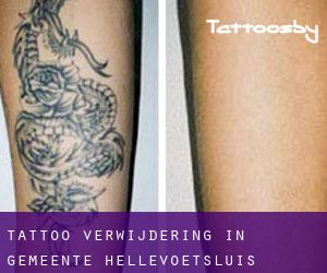 Tattoo verwijdering in Gemeente Hellevoetsluis