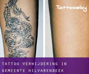 Tattoo verwijdering in Gemeente Hilvarenbeek