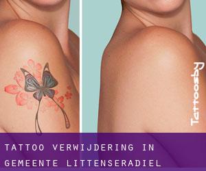Tattoo verwijdering in Gemeente Littenseradiel