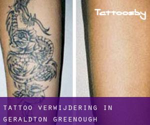 Tattoo verwijdering in Geraldton-Greenough