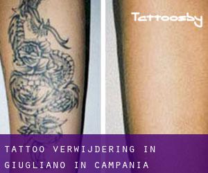 Tattoo verwijdering in Giugliano in Campania
