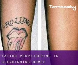Tattoo verwijdering in Glendinning Homes