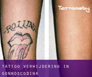 Tattoo verwijdering in Gonnoscodina