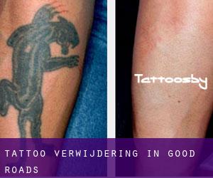 Tattoo verwijdering in Good Roads